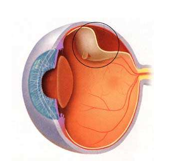 昆明眼科医院，全家眼健康检查，视网膜病变/脱落，高度近视