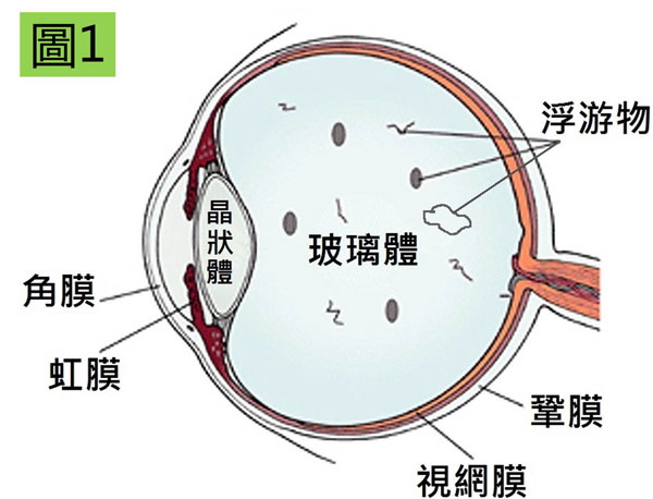 视网膜脱落