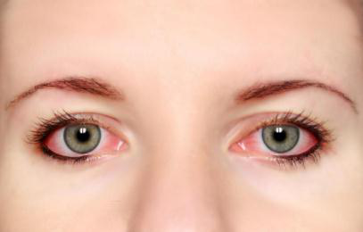眼睛痒异物感是怎么回事,结膜炎用什么眼药水好