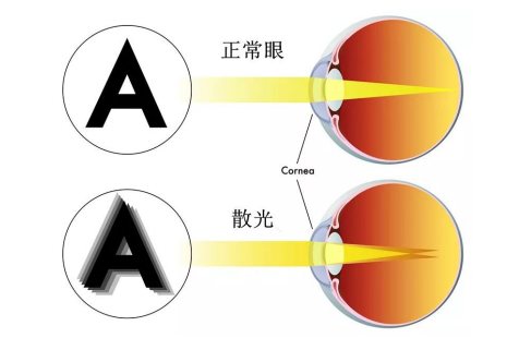 散光怎么矫正有效？