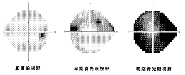 昆明哪里治疗青光眼好？