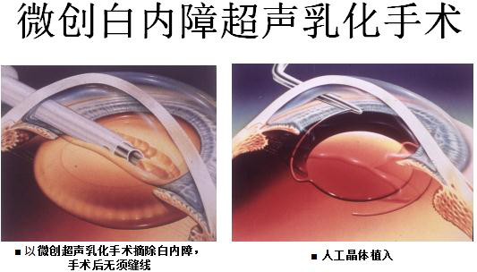 高度近视有哪些并发症？