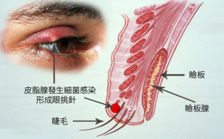 麦粒肿可以用眼药水治疗吗？