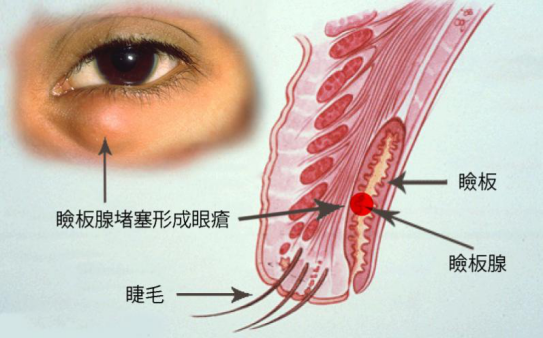 麦粒肿要多久才能好