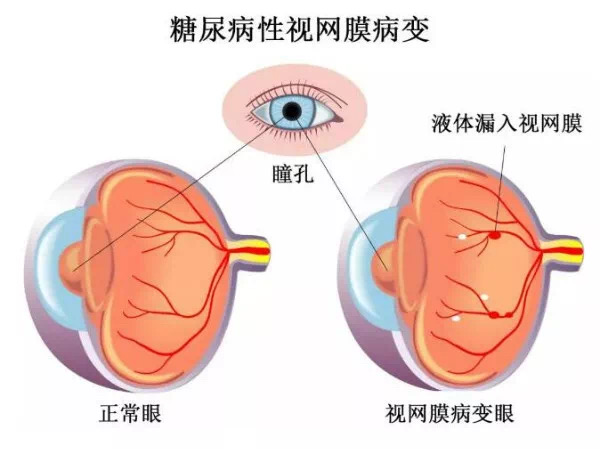 昆明哪家治疗视网膜脱落好