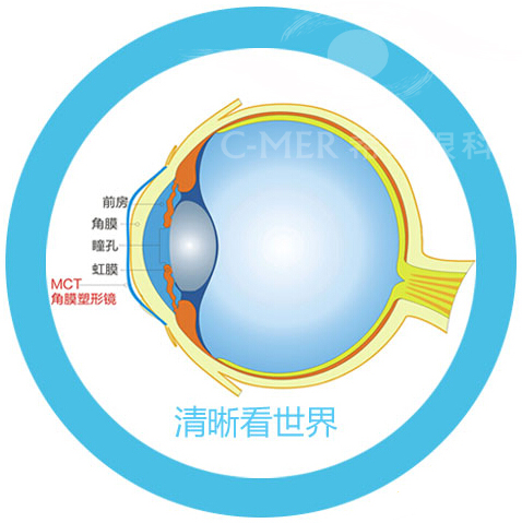 ok镜适合多少岁孩子佩戴？