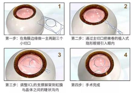 昆明icl手术和激光近视手术对比