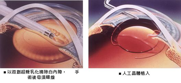 人工晶体,后囊浑浊,眩光,对比敏感度,视力模糊 人工晶体,后囊浑浊,眩光,对比敏感度,视力模糊